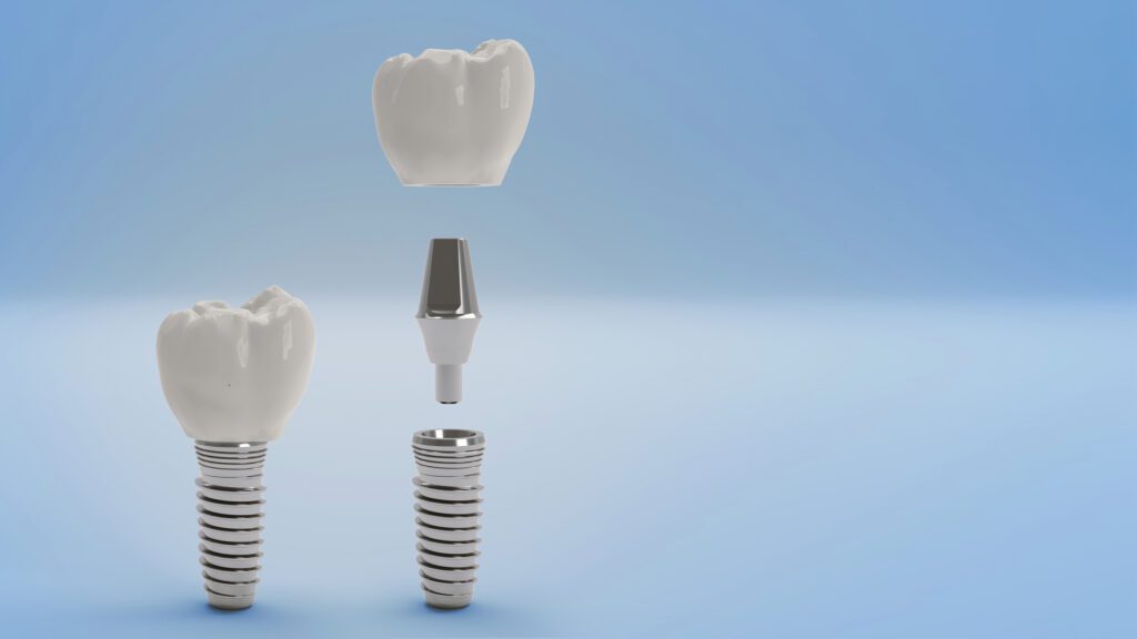 Dental Implants in Dallas, TX