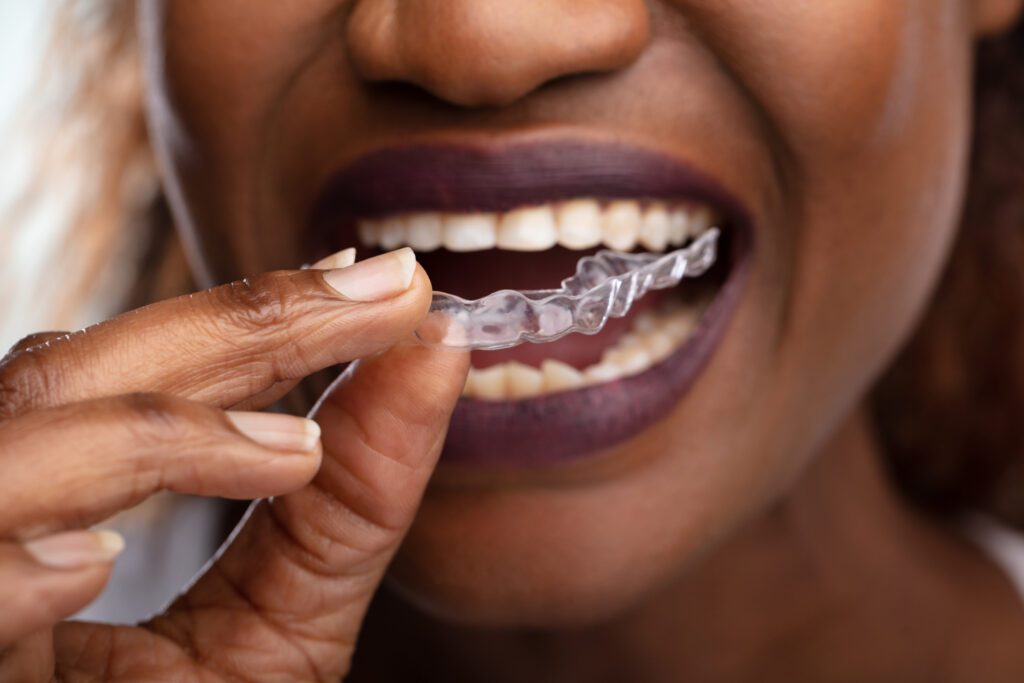 Invisalign Treatment in Dallas TX